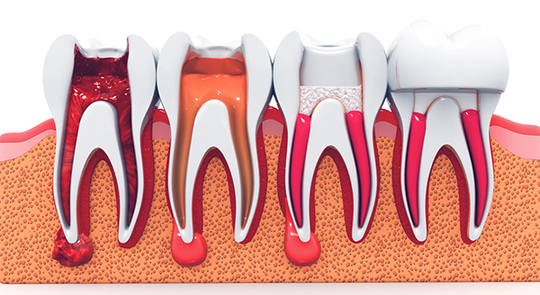 مراحل درمان ریشه دندان چیست؟