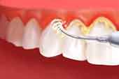 جلوگیری از التهاب لثه با جرمگیری دندان