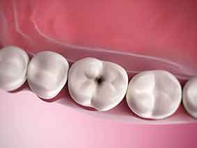 4 عامل پوسیدگی دندان