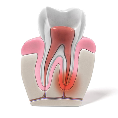 علائم به عصب رسیدن دندان چیست؟